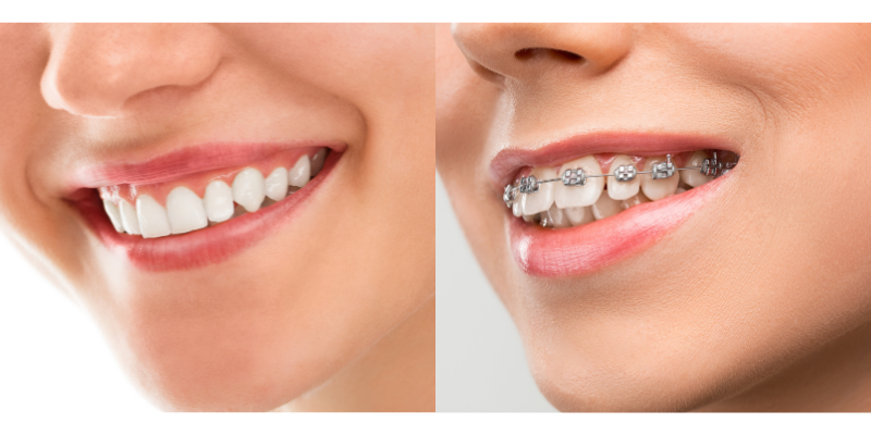 Invisalign Or Braces: Which is Better for You?